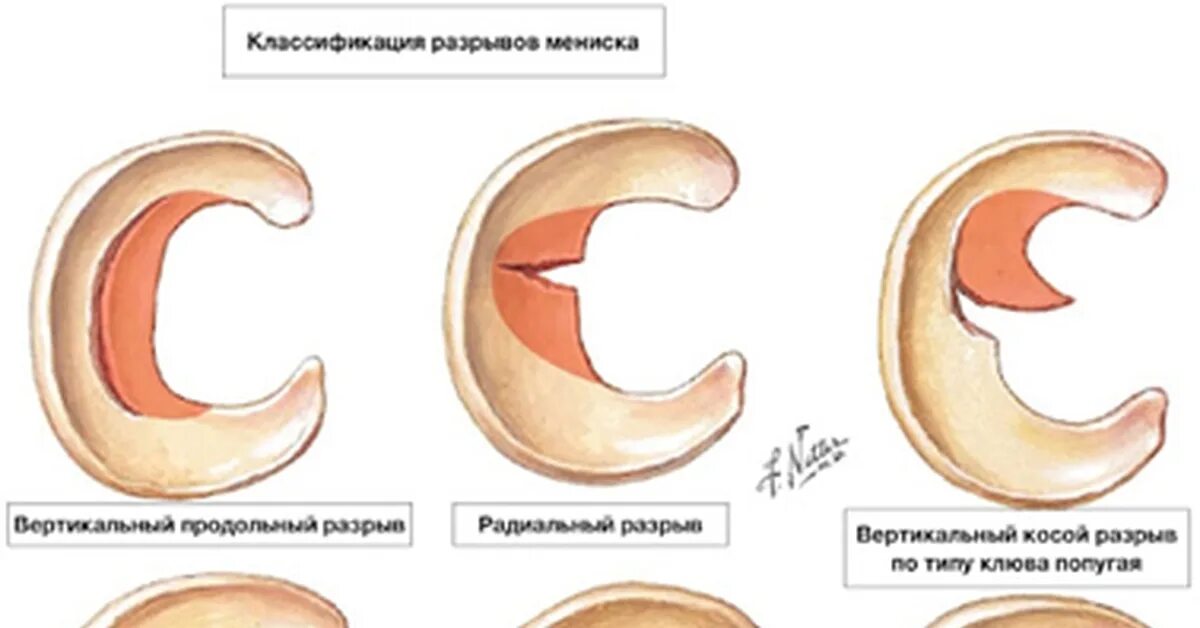 Типы разрывов мениска. Разрыв мениска по типу лейки. Разрыв мениска по типу клюва попугая. Разрыв мениска клюв попугая. Повреждение мениска по типу клюва попугая.