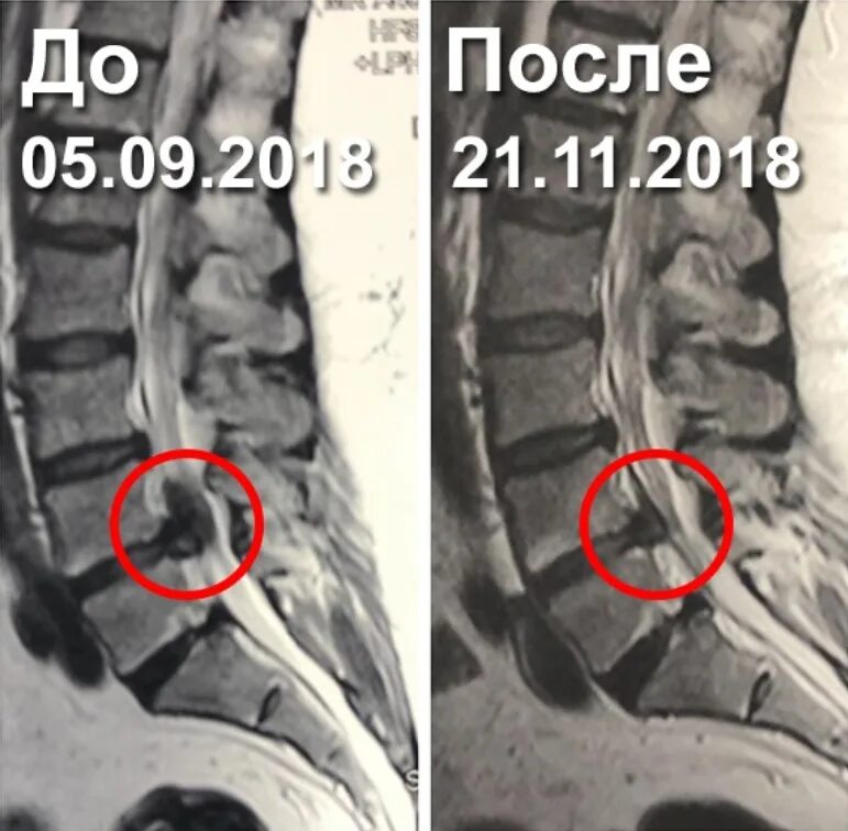 Межпозвонковая грыжа без операции. Грыжа позвонка l5. Позвоночная грыжа s1 l5 операция. Грыжа l5-s1.