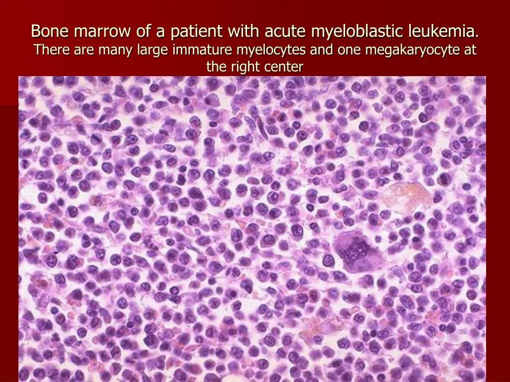 Мозг при остром лейкозе. Острый миелобластный лейкоз гистология. Гистологический препарат острый лейкоз. Хронический миелобластный лейкоз гистология. Лимфобластный лейкоз гистология.