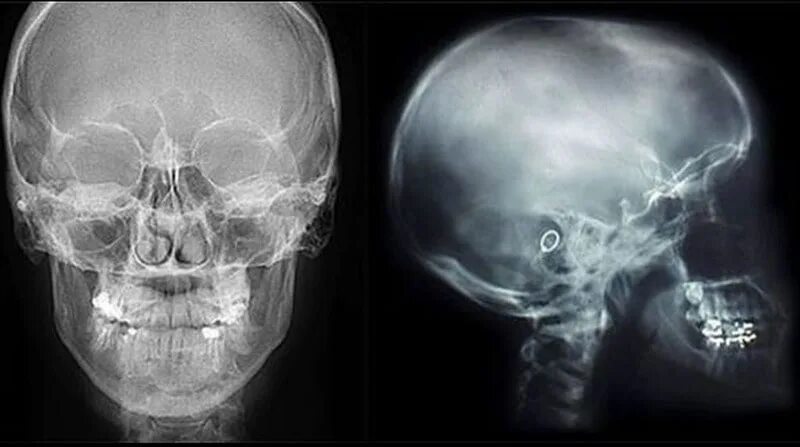 Трещина в голове. Опухоль головного мозга рентген черепа. Рентген костей черепа в 2 проекциях. Рентген черепа сотрясение мозга. Ахондроплазия рентген черепа.