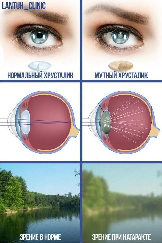 Зрение плюс 3. Хрусталик при катаракте. Изображение при катаракте.