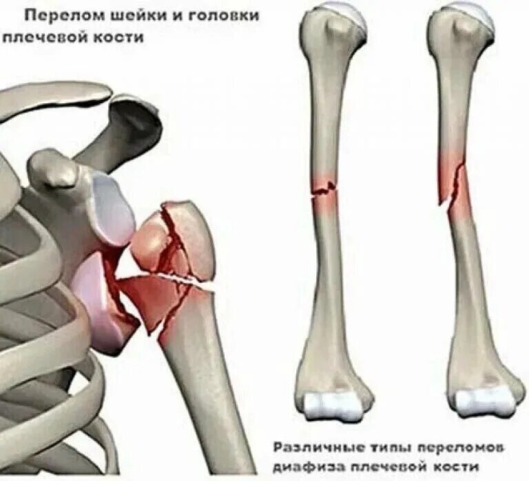 Перелом диафиза плечевой кости. Оскольчатый перелом плечевой кости. Внутрисуставной перелом плечевой кости. Перелом верхней трети диафиза плечевой кости.