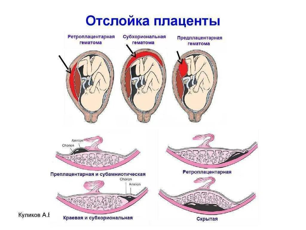 Почему появляются отслойки. Отслоение плаценты при беременности 2 триместр. Диагностические критерии предлежание плаценты. Ранний симптом отслойки плаценты. Беременность отслойка плаценты на ранних сроках беременности.