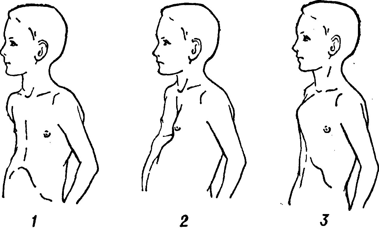 Синдром Марфана деформация грудной клетки. Килевидная грудная клетка у ребенка 2-3года. Килевидная грудная клетка при рахите. Воронкообразная и килевидная деформация грудной клетки у детей. Грудная клетка у ребенка норма