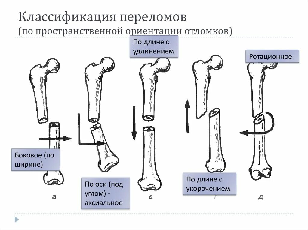 5 групп костей. Классификация переломов по линии излома. Классификация переломов костей конечностей. Классификация переломов по плоскости излома. Классификация переломов по характеру смещения.
