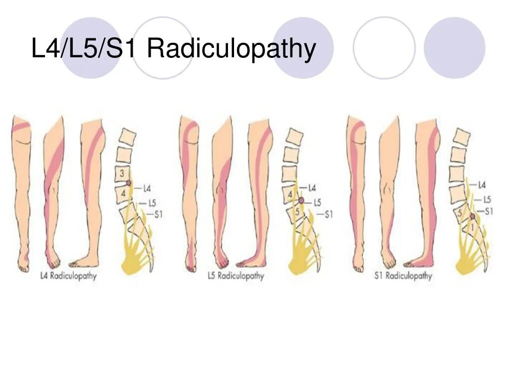 Корешок l3-l4. Радикулопатия l4 l5. Радикулопатия l4 l5. Радикулопатия l4. Радикулопатия l4 l5.