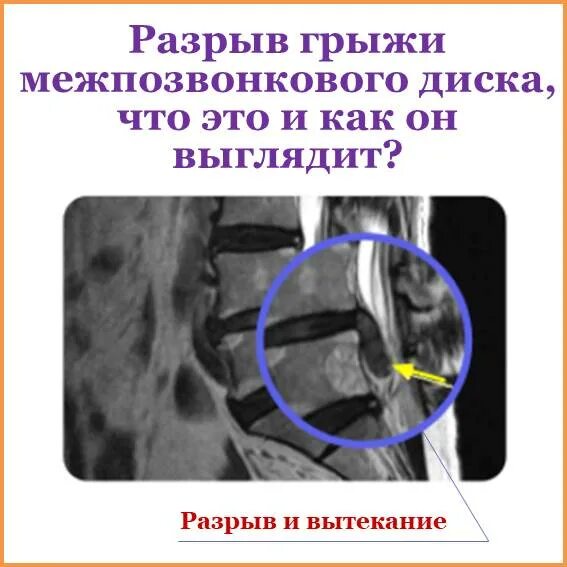 Надрыв фиброзного кольца межпозвоночного диска. Межпозвонковые отверстия поясничного отдела позвоночника. Повреждение фиброзного кольца. Фиброзное кольцо межпозвоночного диска повреждения. Что такое пульпозное ядро позвоночника.