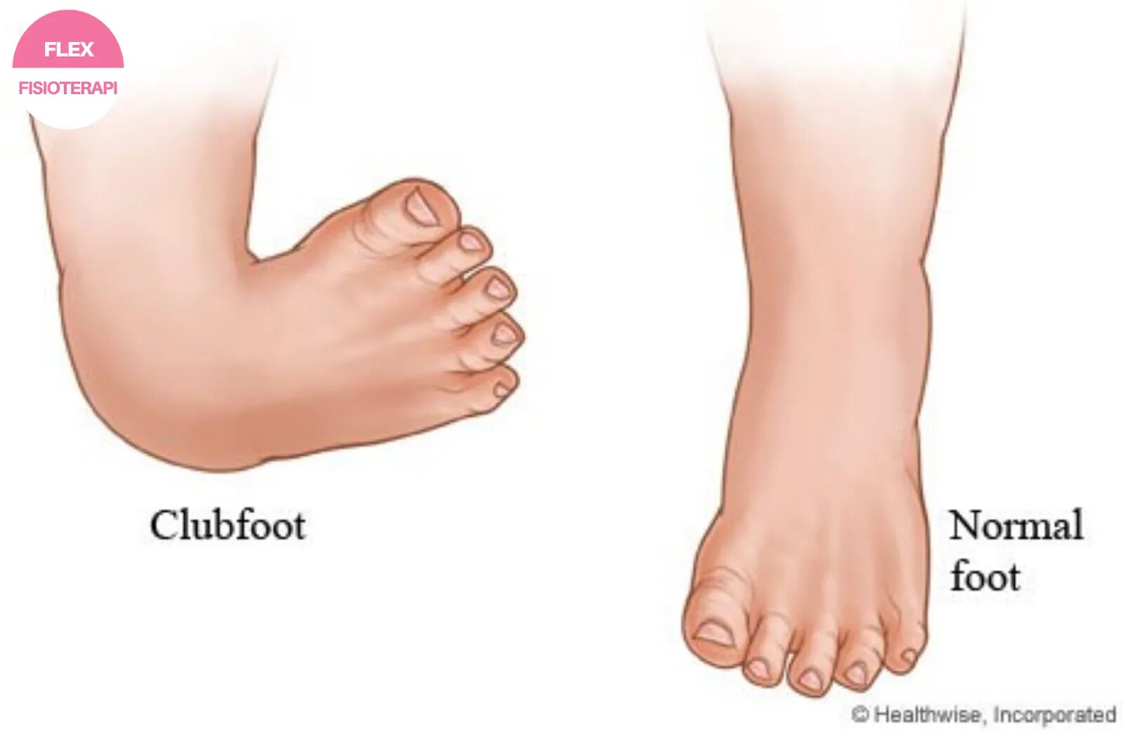 Size different. Club foot перевод. Club foot перевод. Club foot перевод. Подставил ногу.