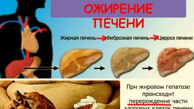 Можно чеснок при жировом гепатозе печени. Диета при жировом гепатозе. жировой гепатоз печени диета. печень при жировом гепатозе. диета при жировом гепатозе печени.