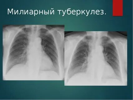 Милиарный туберкулез