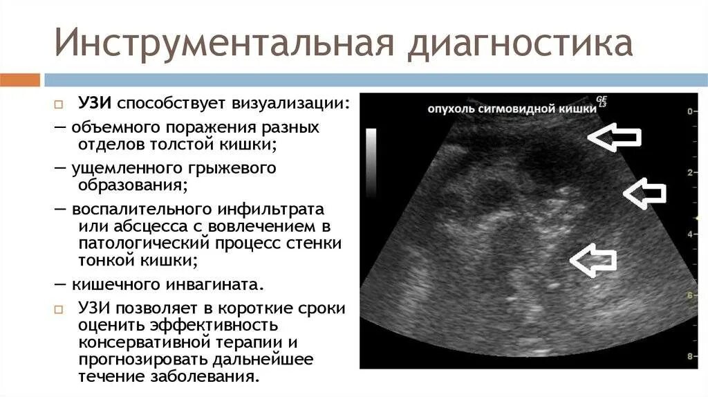 Узи после лечения. УЗИ при динамической кишечной непроходимости. Динамическая кишечная непроходимость на УЗИ. Острая кишечная непроходимость УЗИ. Кишечная непроходимость УЗИ протокол.