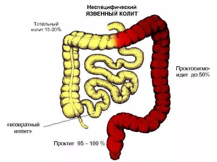 Няк что это за болезнь. Клинические проявления язвенного колита. Неспецифический язвенный колит проктит. Язвенный колит толстой кишки. Что такое язвенный колит Толстого кишечника.