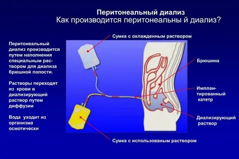 Перитонеальный