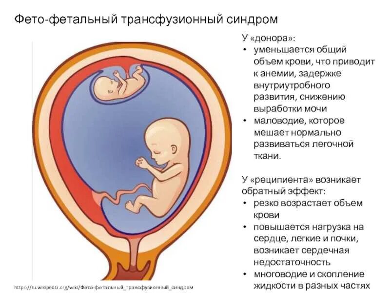 Синдром донора. Фетофентальный синдром. Фето фетальный синдром. Фето-фетальный трансфузионный синдром (ФФТС). Фета фертильный синдром.