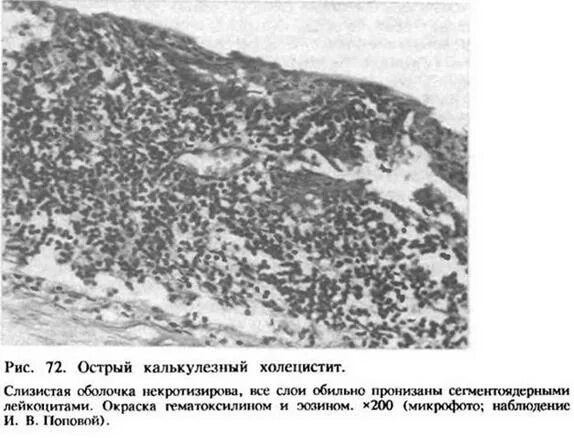 Острый холецистит патанатомия гистология. Калькулезный холецистит гистология. Острый калькулезный холецистит патанатомия. Хронический калькулезный холецистит гистология.