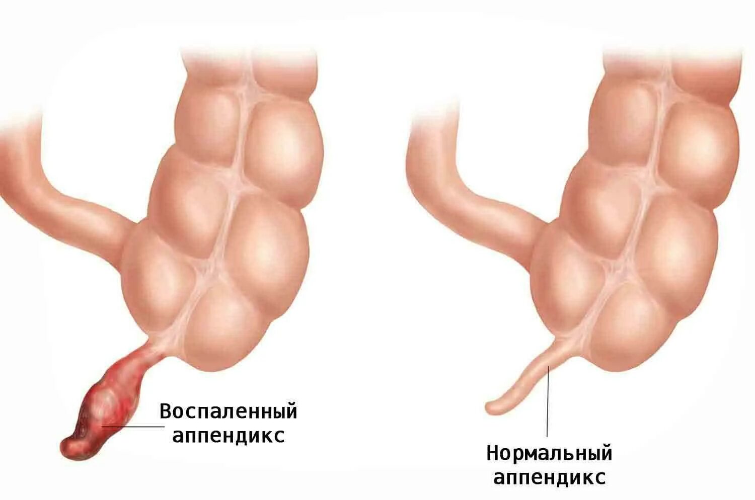Какую категорию годности поставят с аппендицитом Призовут ли с аппендицитом