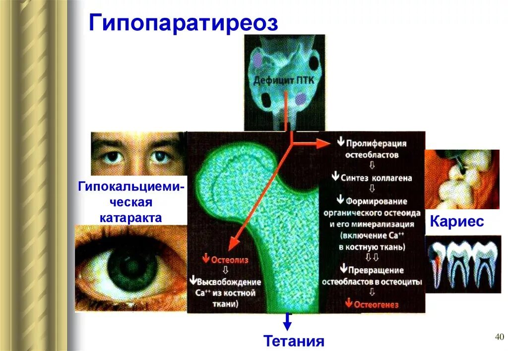 Гипопаратиреоз клинические синдромы. Клинические симптомы гипопаратиреоза. Основные проявления гипопаратиреоза.. Клинические проявления гепопаратериоз.