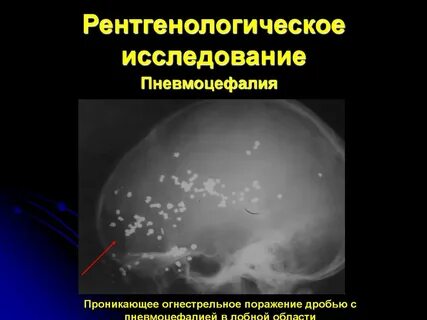 Пневмоцефалия