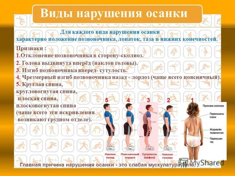 Слабая мускулатура приводит к нарушениям осанки. Типы осанки. главная причина нарушения осанки. таблица причин нарушения осанки. наиболее частыми нарушениями осанки являются.
