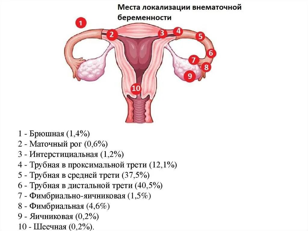 Удаление матки будут ли месячные. Трубная беременность внематочная интерстициальная. Матка внематочная беременность. Формы внематочной беременности. Локализация маточной беременности.