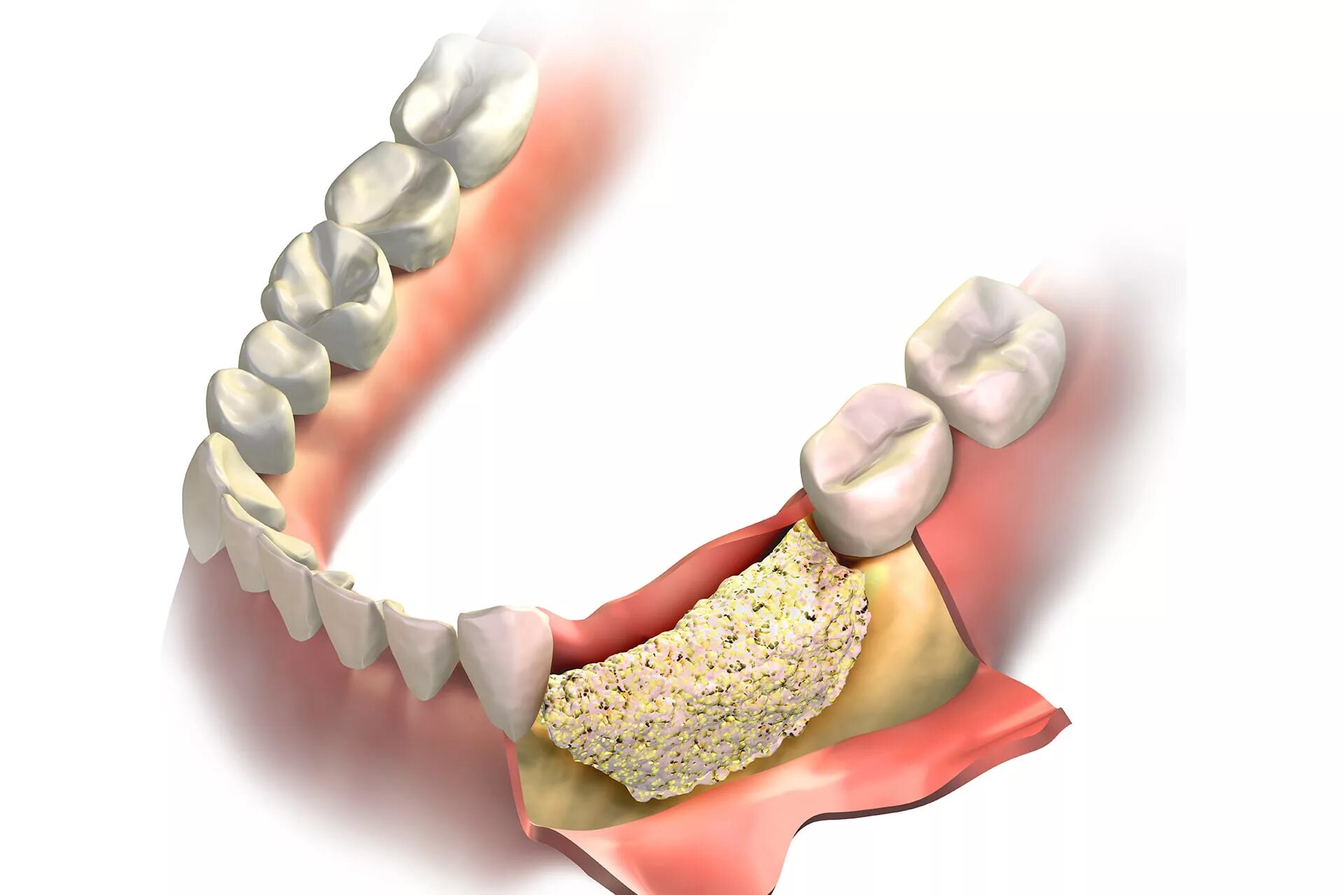 синус-лифтинг (костная пластика, остеопластика). протезирование костной ткани. имплантация зубов с костной пластикой. остеопластика челюстей. синус-лифтинг гайморова пазуха.