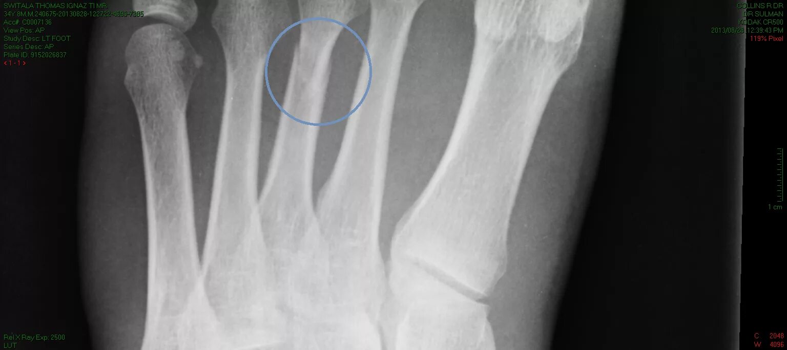 Перелом пальца на ноге снимок.