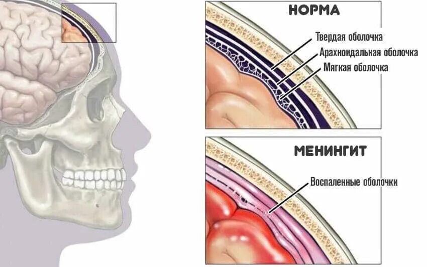 Поражение оболочек мозга. Отогенный Гнойный менингит. Серозный вирусный менингит. Менингит воспаление мозговых оболочек. Асептический менингит.