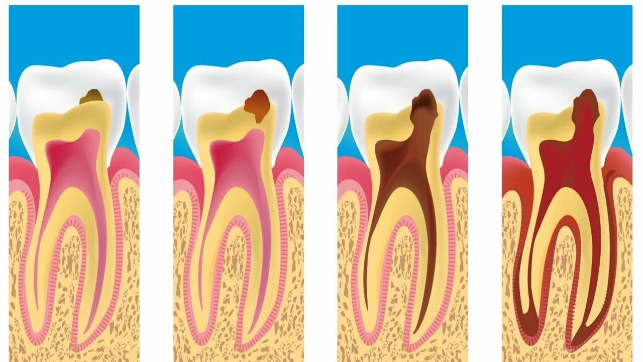 Пульпит это осложнения кариеса. Стадии развития пульпита. Осложнения лечения пульпита