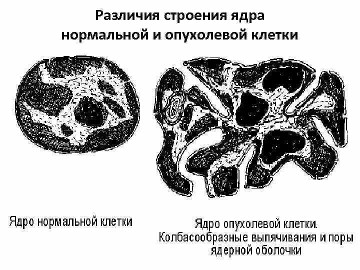 Чем различается строение. Ядро опухолевой клетки. гиперхроматоз ядра опухолевой клетки. строение опухолевой клетки.