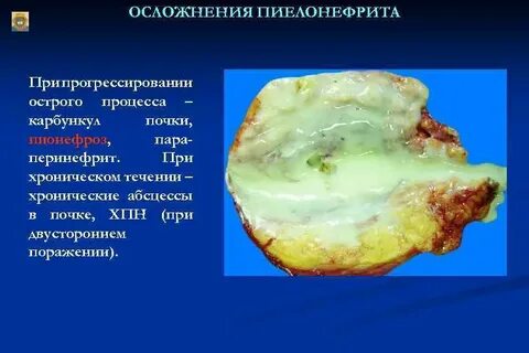Пиелонефрит осложнения