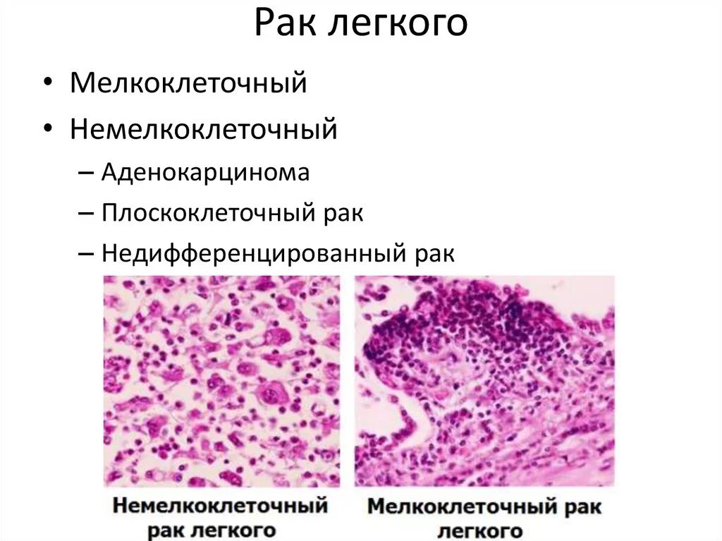 Плоскоклеточная карцинома легкого гистология. Плоскоклеточная карцинома кожи гистология. Низкодифференцированная аденокарцинома легкого гистология. Гистологическая классификация опухолей легкого. Низкодифференцированный плоскоклеточный рак