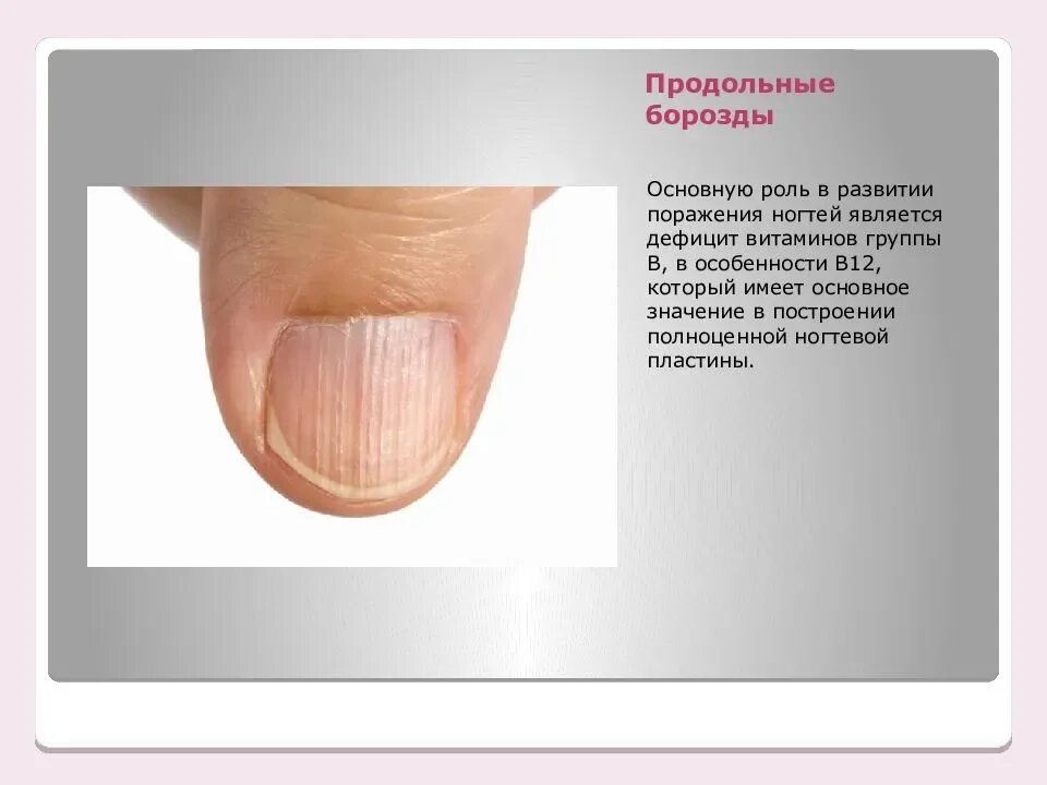 Что означают полосы на ногтях. Болезни ногтей продольные бороздки. Продольные борозды на ногтях. Бороздки на ногтевой пластине. Поперечные и продольные борозды ногтевой пластины.