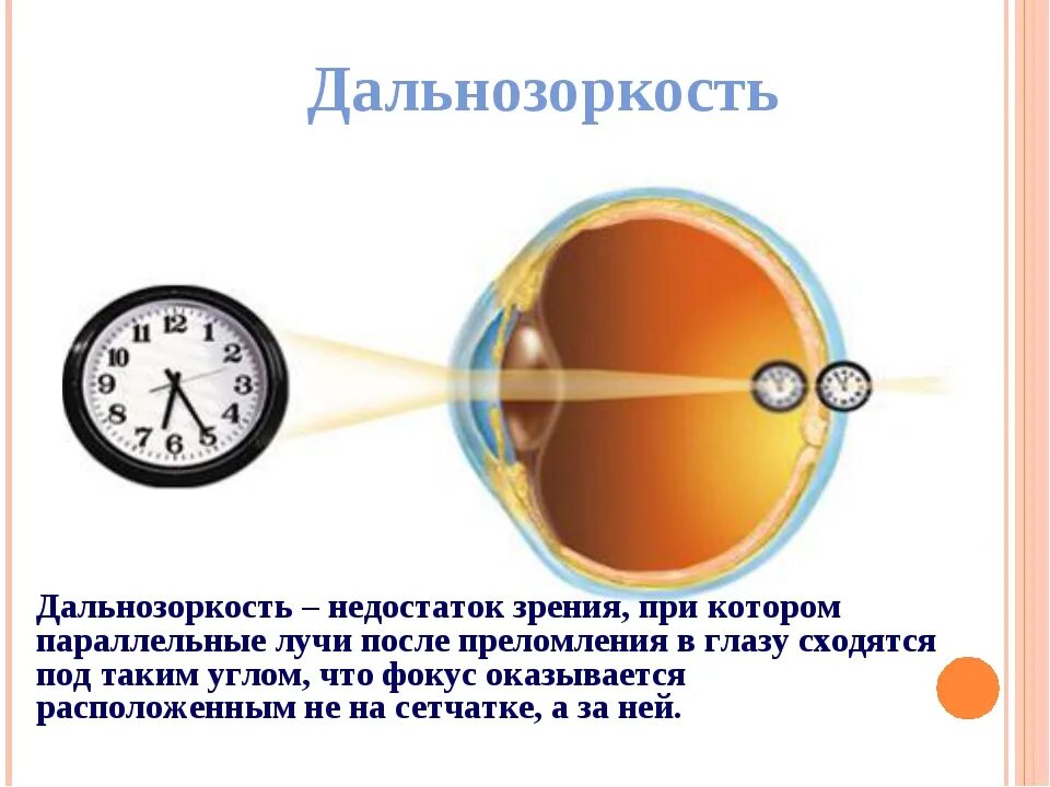 Дальнозоркость форум. Дальнозоркость. недостаток дальнозоркости. дальнозоркость зрачок. дальнозоркость схема глаза.