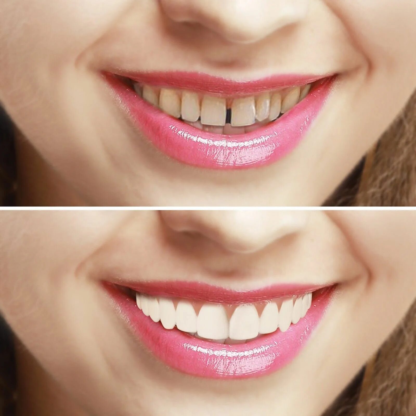 Виниры-элайнеры Snap-on smile. Cъемные виниры perfect smile Veneer (Snap on smile). Красивые зубы. Быть идеально ровной