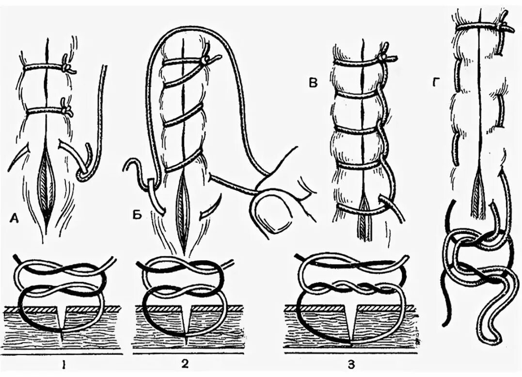 Техника наложения непрерывного матрацного шва. Обвивной матрацный шов. Обвивной непрерывный кетгутовый шов. Непрерывный обвивной шов в хирургии. Как называется шов после операции