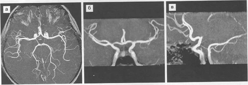 Задние соединительные артерии кт. Аплазия позвоночной артерии. Гипоплазия мозговой артерии. Гипоплазия правых синусов