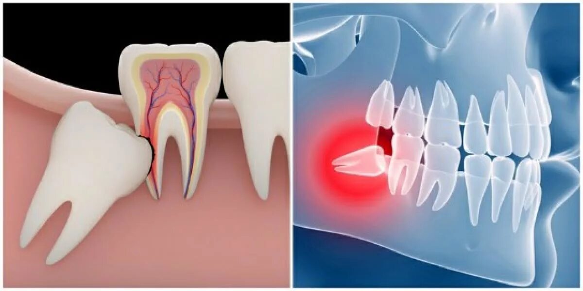 Зуб мудрости восьмерка. Удаленные зубы мудрости. Зуб 8 корень
