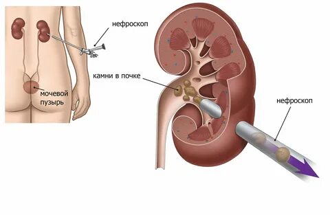 Стенд в почке при камнях - Telegraph