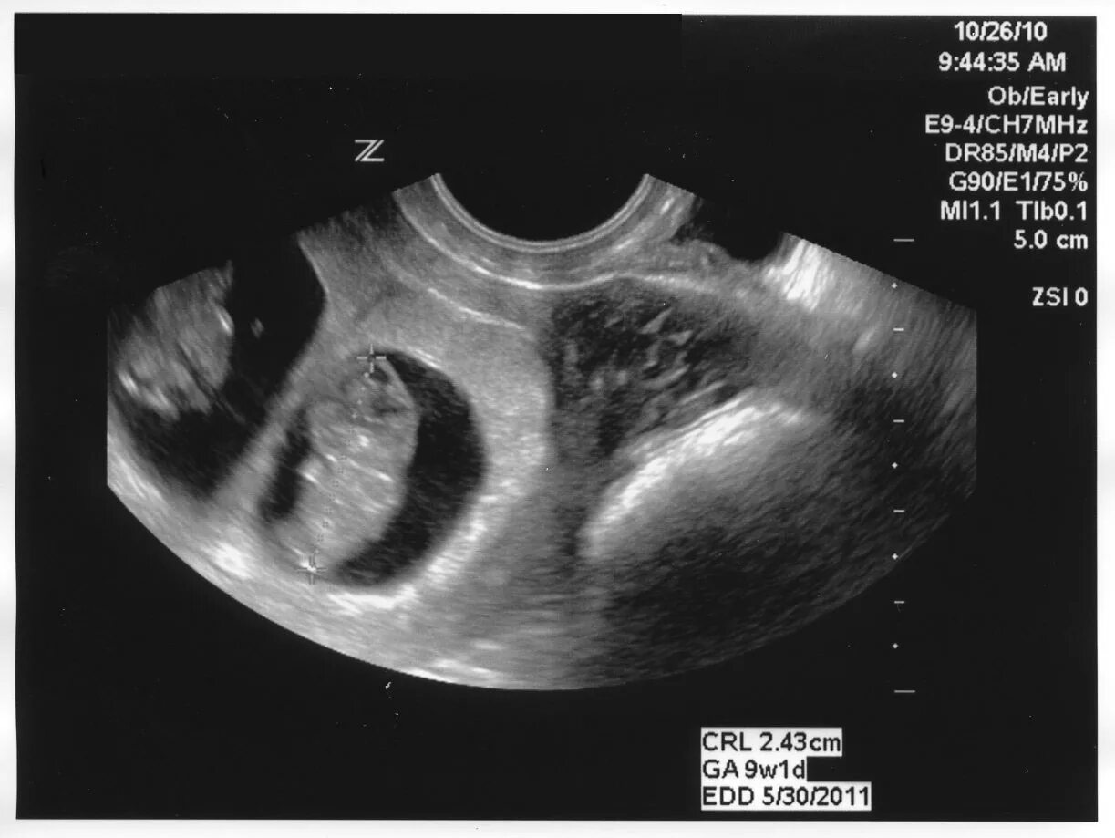 Плод на 9 неделе беременности УЗИ. Эмбрион на 9 неделе беременности УЗИ. УЗИ 9 недель беременности. Размер плода в 9 недель беременности по УЗИ.
