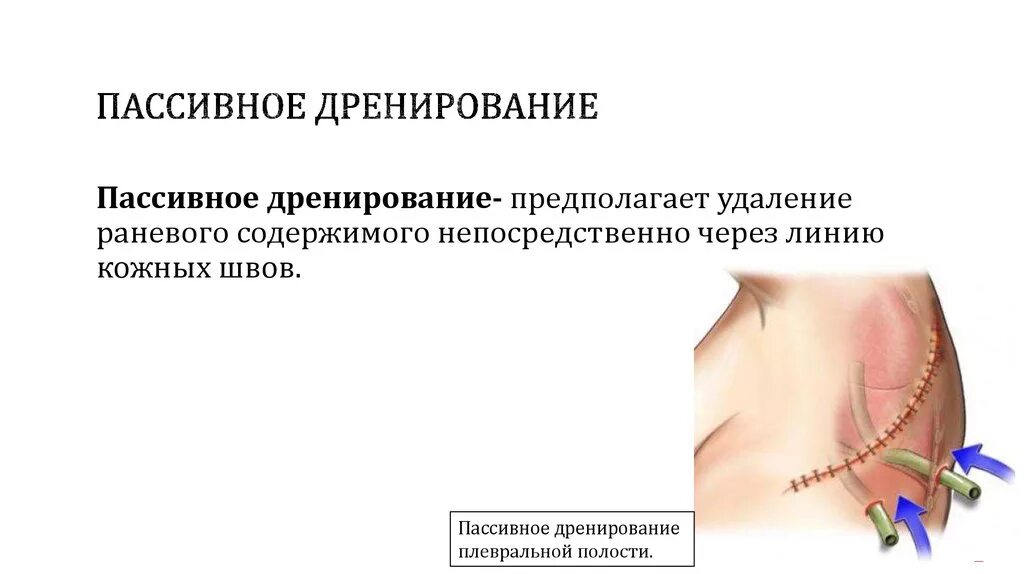 Пассивное дренирование. Пассивное и активное дренирование ран. дренирование пассивное активное проточно-промывное. пассивное дренирование ран. активное дренирование ран.