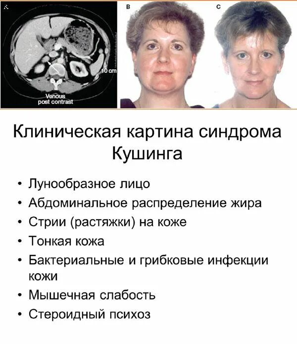 Аденома гипофиза Иценко Кушинга симптомы. Синдром Иценко-Кушинга это опухоль –. Синдром Иценко -Кушинга пациенты. Патологии гипофиза симптомы у женщин. Нарушения работы гипофиза заболевания