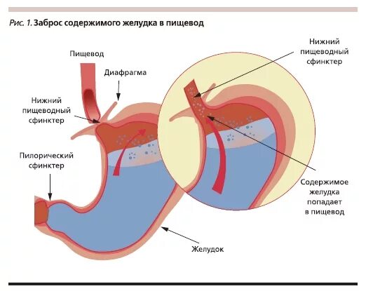 Желчные кислоты в желудочном соке. Заброс содержимого желудка в пищевод. Заброс желчи в желудок в желудок.