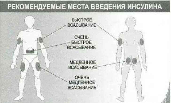 Алгоритм введения инсулина детям. Алгоритм введения инсулина детям