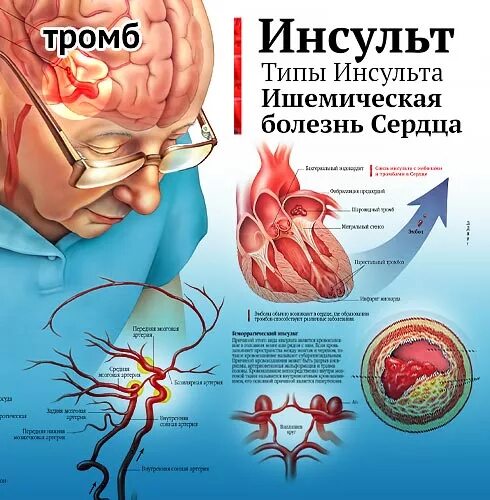 Тромбы после инсульта. Инсульт. Болезнь инсульт сердца. Ишемический сердечный инсульт.