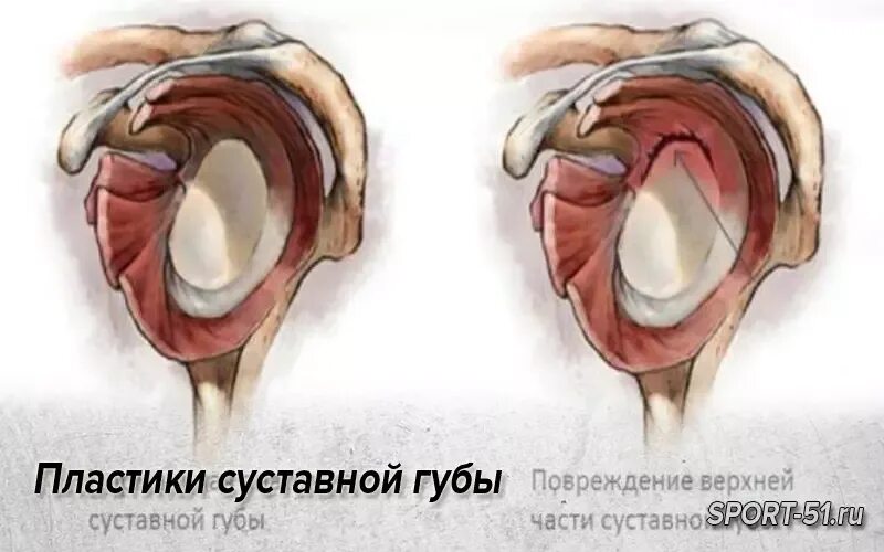 Повреждение суставной губы гленоида. Суставная губа гленоида плечевого сустава. Слэп повреждение плечевого сустава. Разрыв суставной губы гленоида.