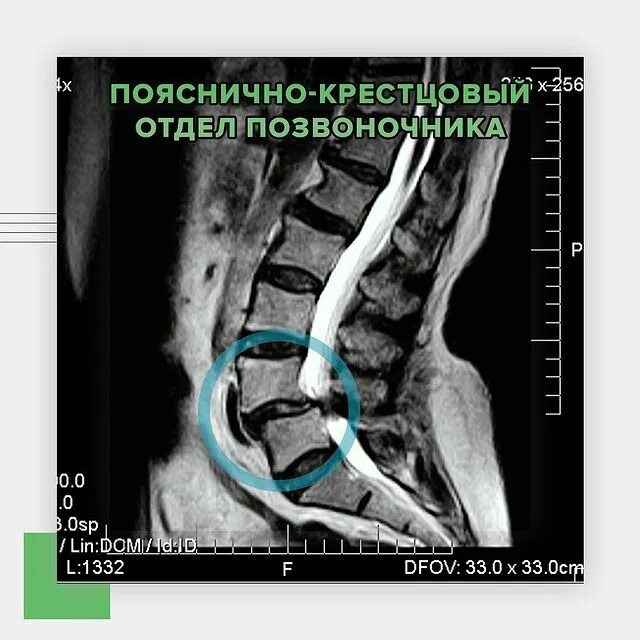 Мрт пояснично крестцового отдела сколько по времени. Пояснично-крестцовый отдел. мрт пояснично-крестцового отдела снимки с описанием. результаты мрт пояснично-крестцового отдела. мрт поясничного отдела пациент.