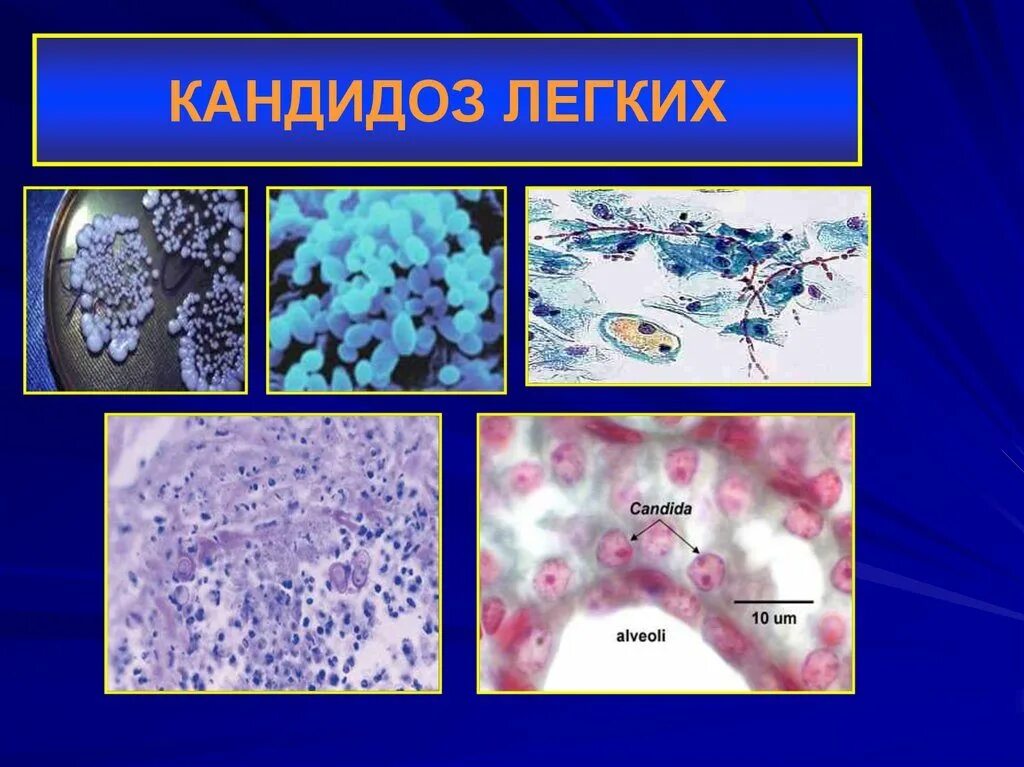 Candida чем лечить. Грибковая инфекция кандидоз. Бронхолегочный кандидоз.