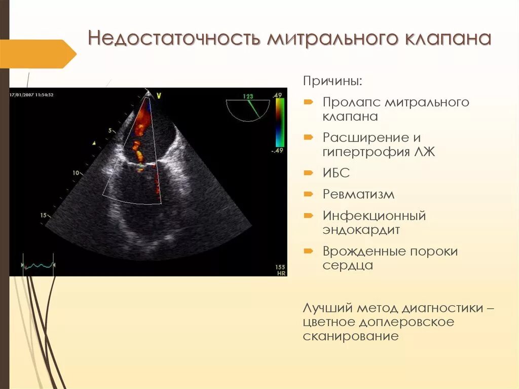 Что такое пролапс митрального клапана. Подклапанный аппарат митрального клапана. Пролапс митрального клапана. Пролапс митрального клапана диагноз. Недостаточность митрального клапана диагноз.