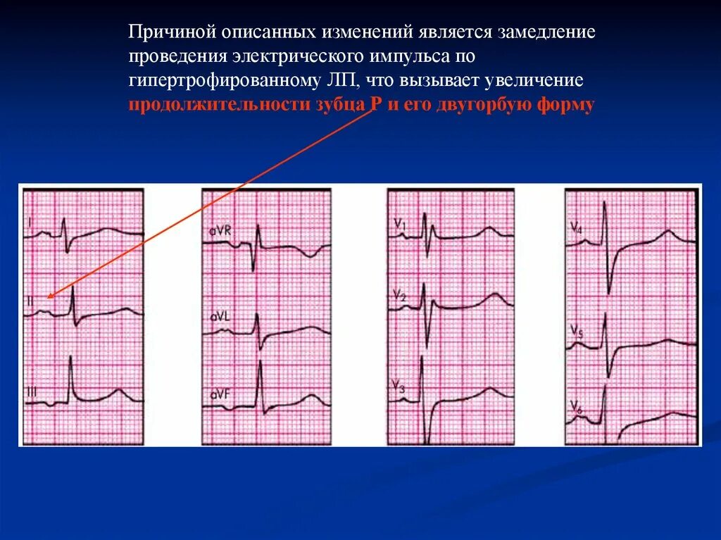 Причины гипертрофии левого желудочка. Двугорбый зубец р на ЭКГ. ЭКГ при гипертрофии желудочков. Изменение ЭКГ при гипертрофии правого желудочка. S Тип гипертрофии правого желудочка.