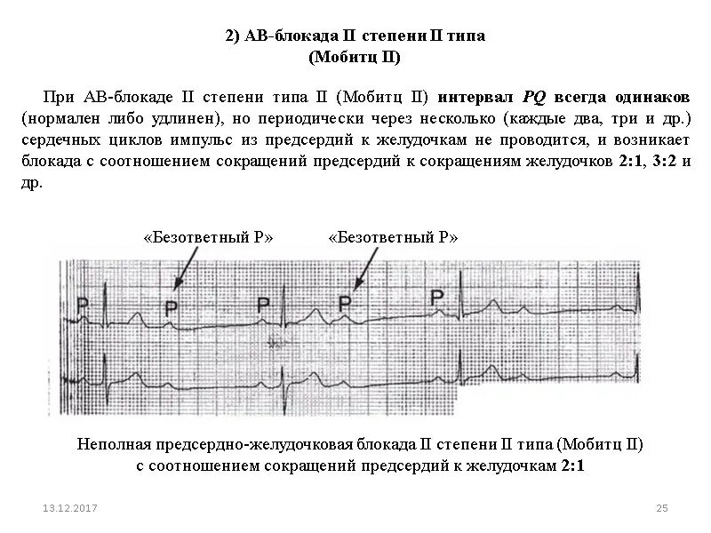 Блокада инструкция. ЭКГ при АВ блокаде 2 степени Мобитц. АВ блокада 2 степени типа Мобитц 2. АВ блокада 2 степени 1 типа Мобиц. Атриовентрикулярная блокада 2 степени на ЭКГ.